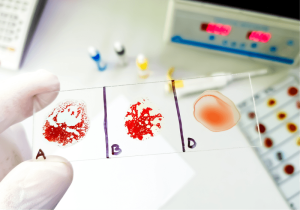The Most Common and Rarest Blood Groups in Pakistan
